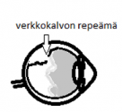 Silmän läpileikkaus, joka kuvailee verkkokalvon repeämää